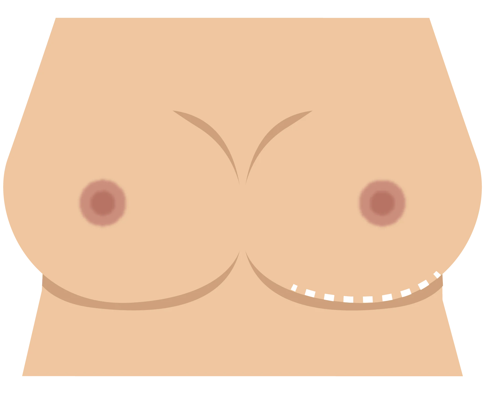 Inframammary incision pattern