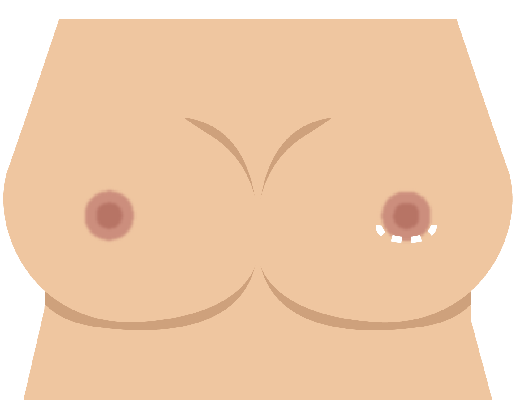 Periareolar incision pattern