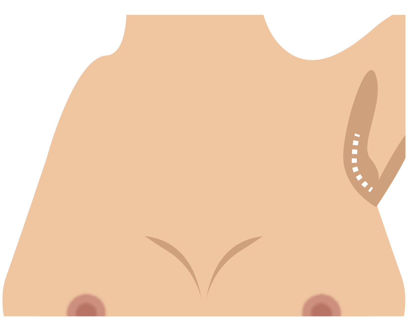 Transaxillary incision pattern