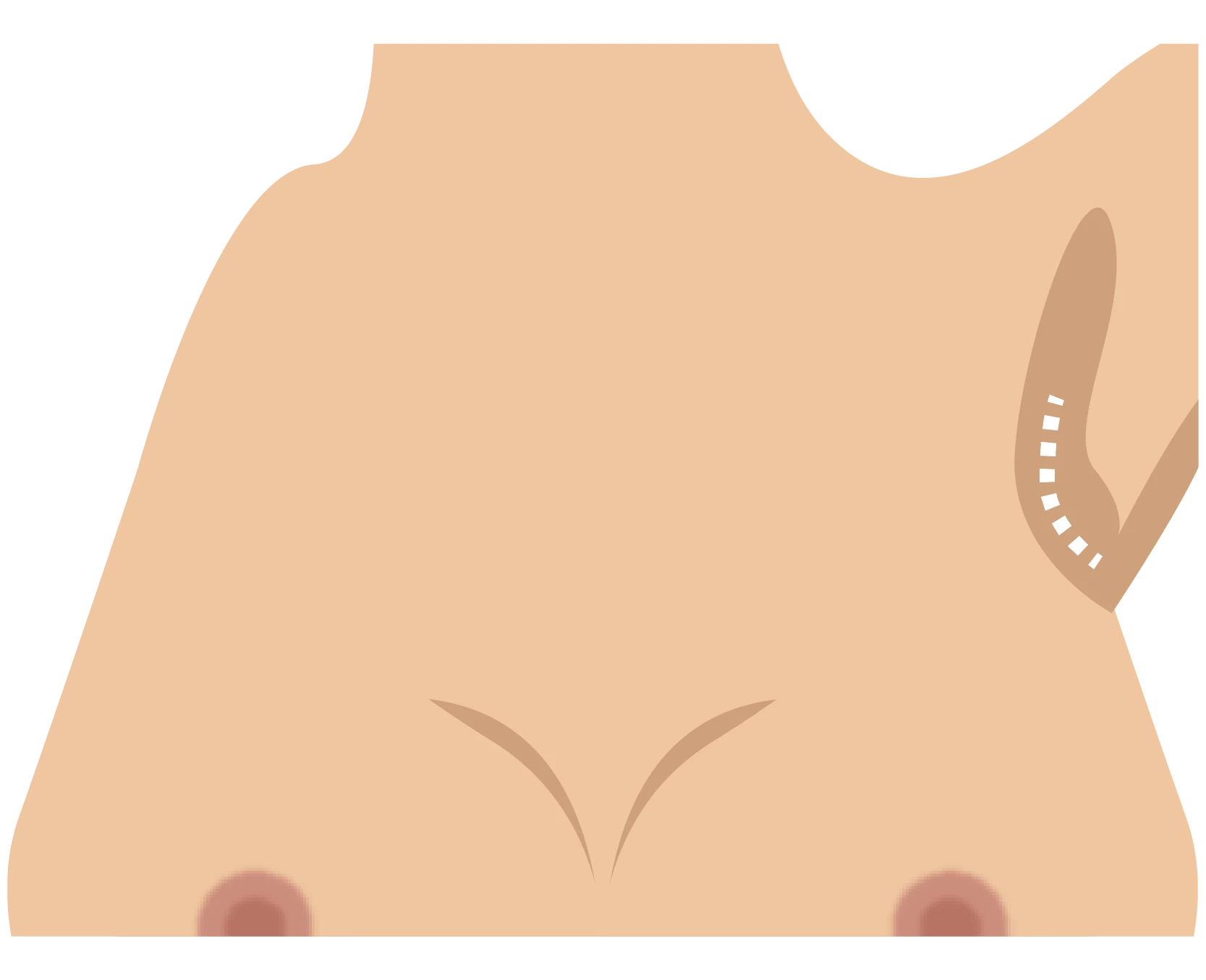 Transaxillary incision pattern