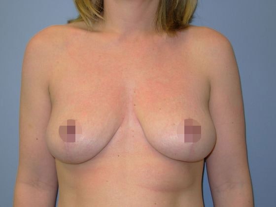 After Breast Lift