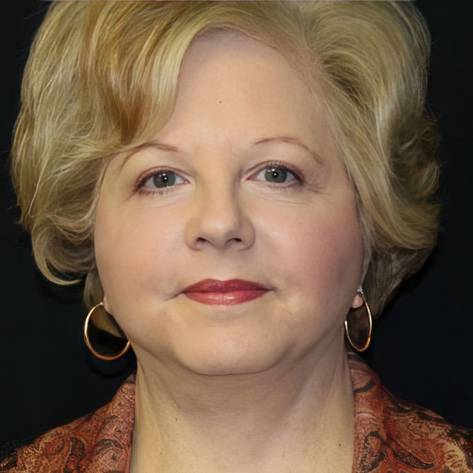 Real Patient after facelift photo