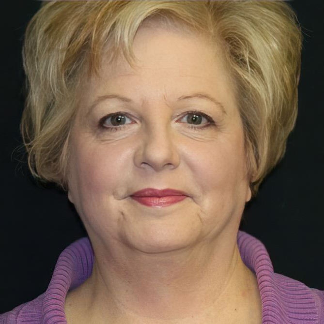 Real Patient before facelift photo