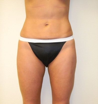 Dr. Ken Smart's patient after liposuction