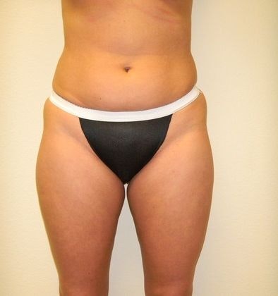 Dr. Ken Smart's patient before liposuction