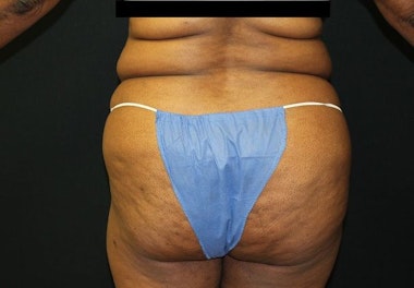Dr. Ken Smart's patient before liposuction from back