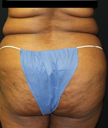 Dr. Ken Smart's patient before liposuction from back
