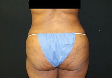 Dr. Ken Smart's patient after liposuction from back