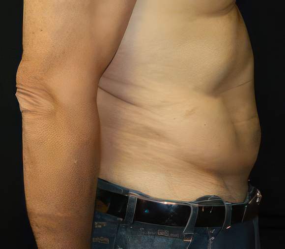 Dr. Ken Smart's patient after liposuction