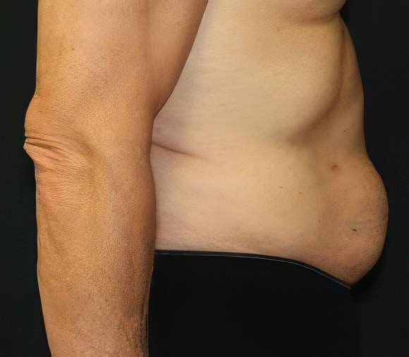 Dr. Ken Smart's patient before liposuction