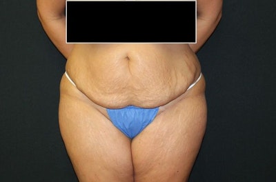 Before: tummy tuck