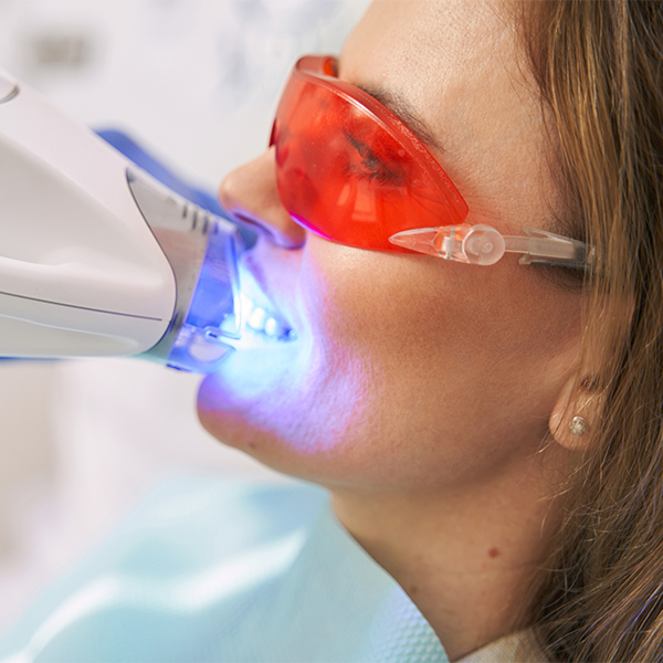 In-office teeth whitening