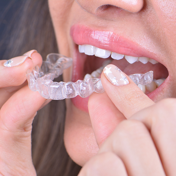 Person placing Invisalign in her mouth