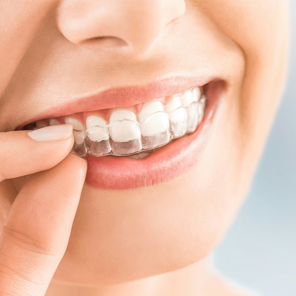 a woman wearing Invisalign