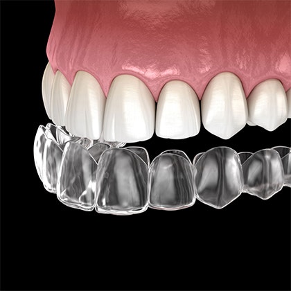 clear orthodontic aligners