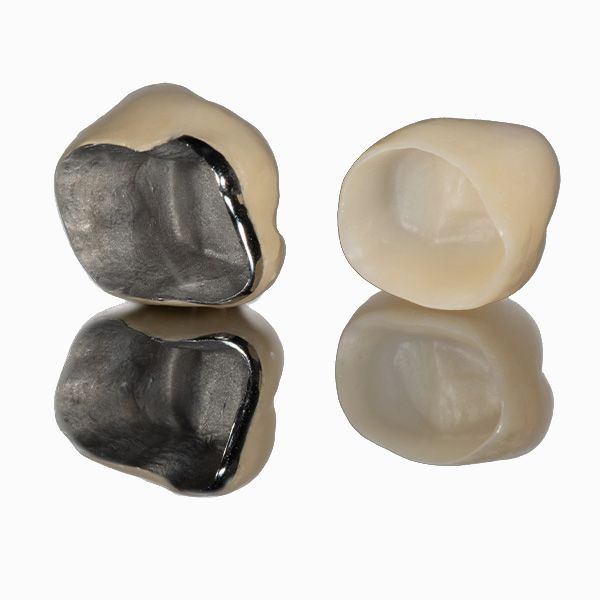 A PFM crown and all-porcelain crown