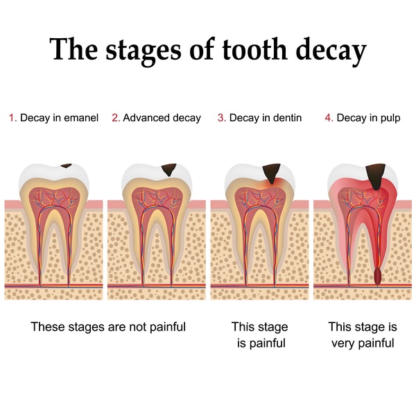 Stages of tooth decay: 1. Decay in enamel. This stage is not painful. 2. Advanced decay. This stage is not painful. 3. Decay in dentin. This stage is painful. 4. Decay in pulp. This stage is very painful.