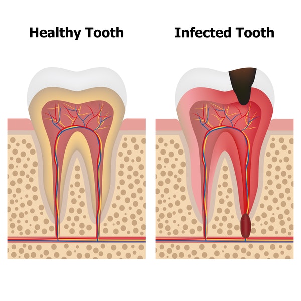 A healthy tooth with no decay of the enamel alongside an infected tooth that has enamel decay.