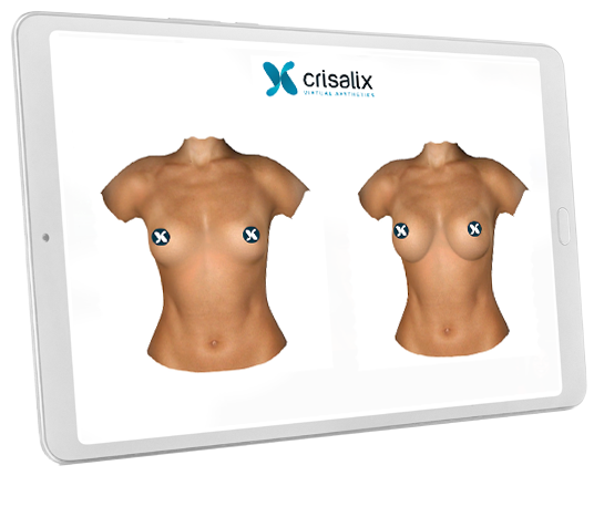 Crisalix 3D imaging