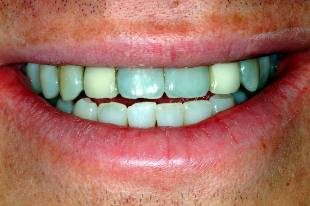 Before Dental Crowns