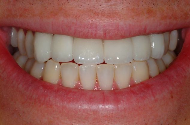 After Dental Crowns
