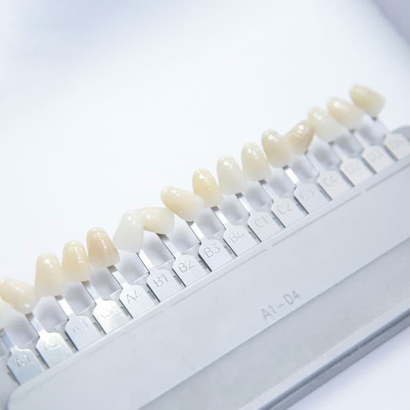 Dental Veneers