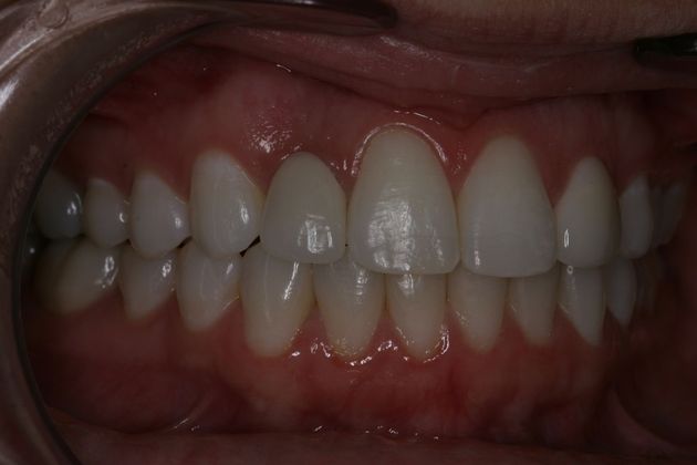 Advanced Dental Care patient after implant placement