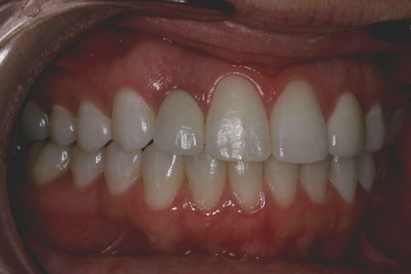 Advanced Dental Care patient after implant placement