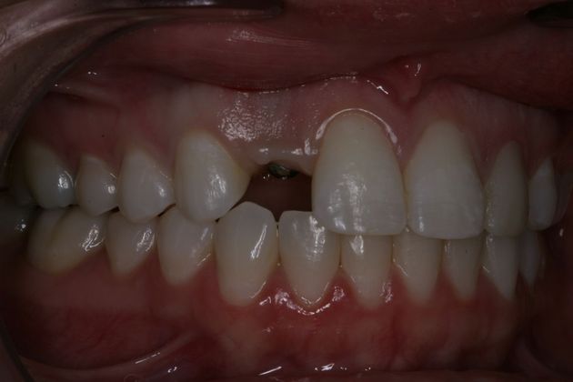 Advanced Dental Care patient before implant placement