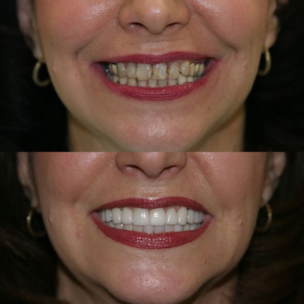 Before and after a smile makeover done at our practice