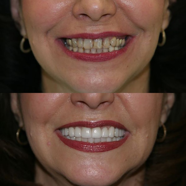 How to Achieve Straighter Teeth With a Smile Makeover - Chamblee Dental  Care Chamblee Georgia