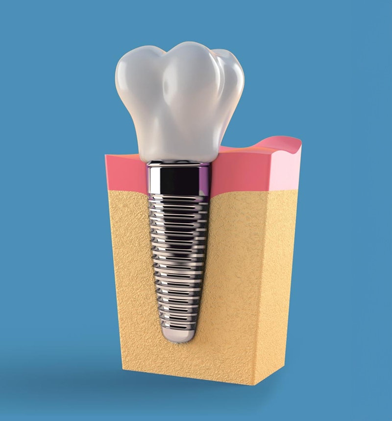Implant Crowns