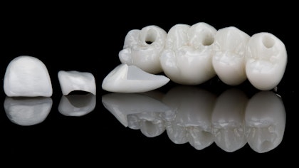 Dental veneers and a dental bridge