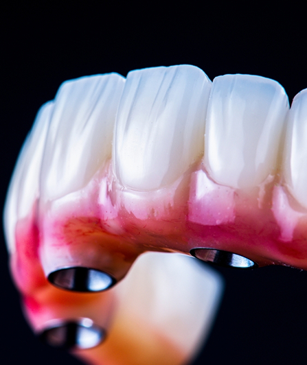 full arch implants close up