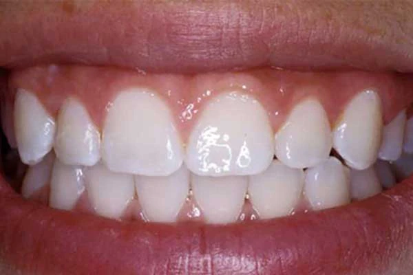 after dental treatment