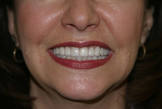 after a smile makeover