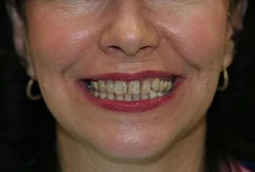 before a smile makeover