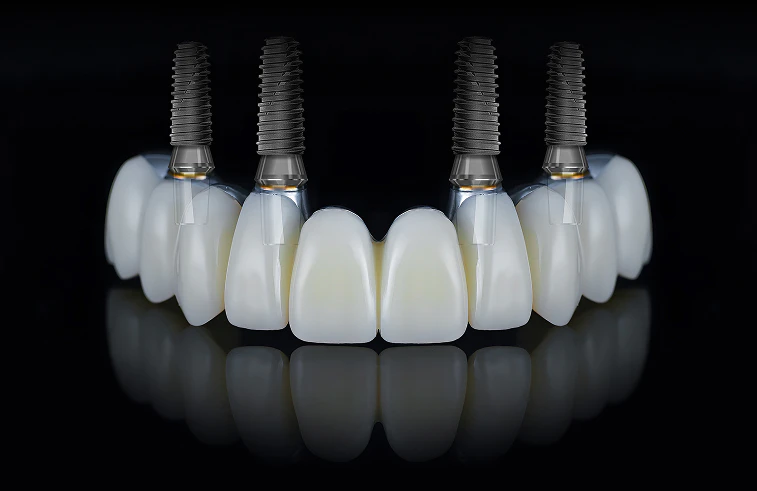 all-on-4 teeth and implants