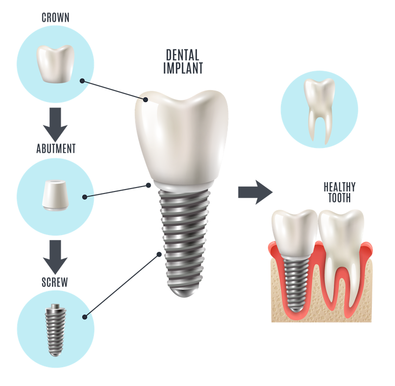 illustration of dental implant
