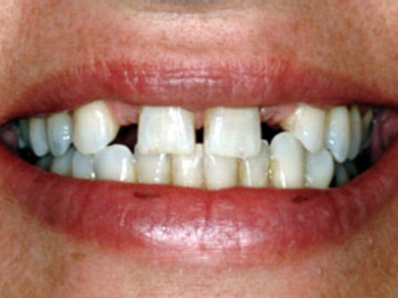 Porcelain veneers before photo