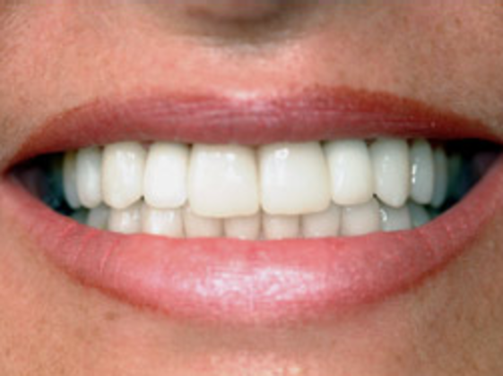 Porcelain veneers after photo