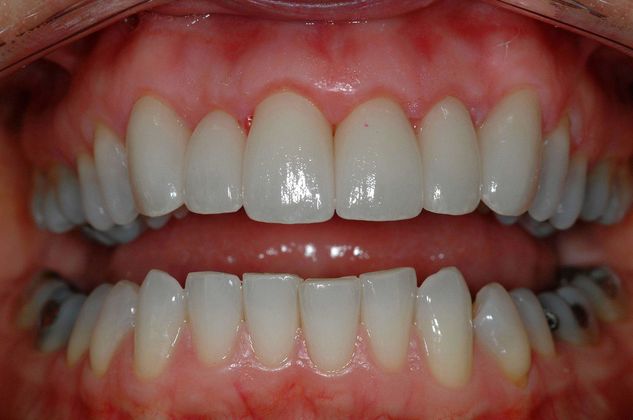 After smile makeover