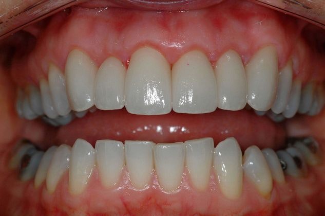 After smile makeover