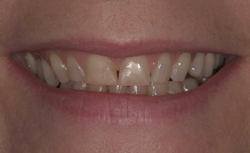 Dr. Berbari's patient before veneers