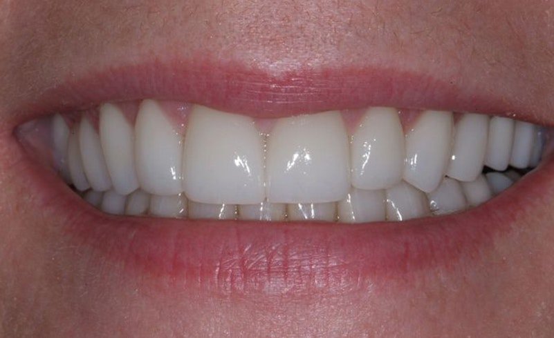Dr. Berbari's patient after veneers