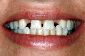 Before dental implants