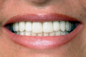 After dental implants