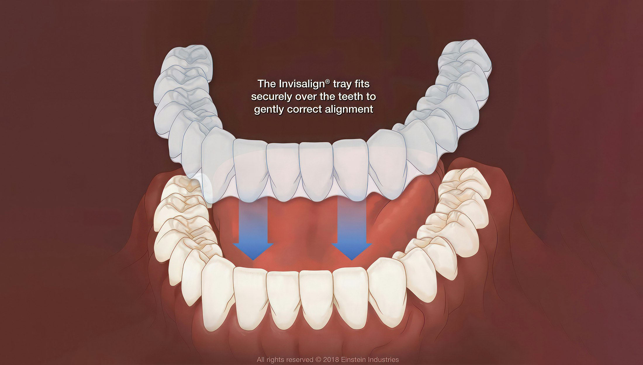 A diagram showing how Invisalign trays fit over a lower arch of teeth.