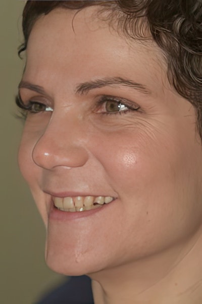 smiling woman before smile makeover