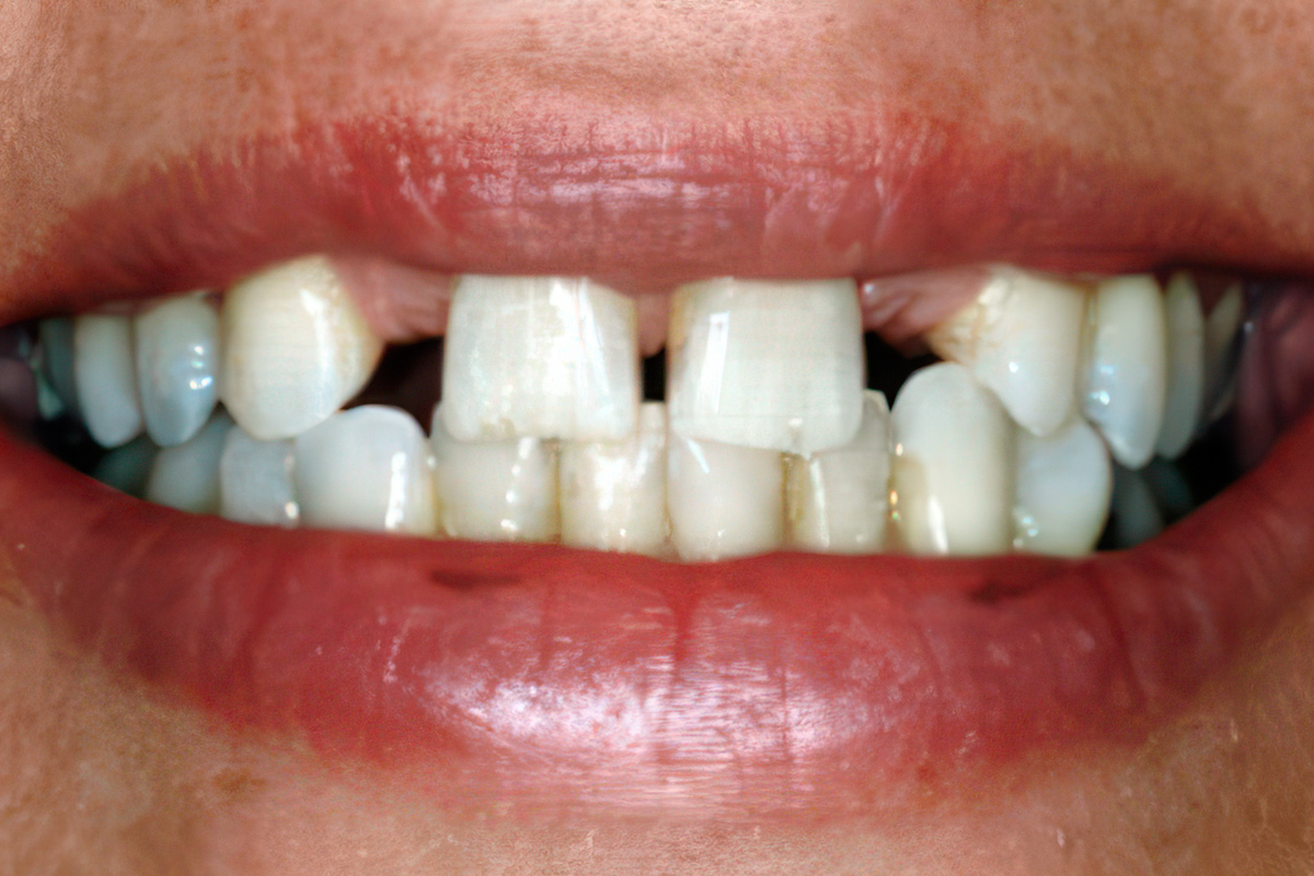 Dr. Berbari's patient before a smile makeover